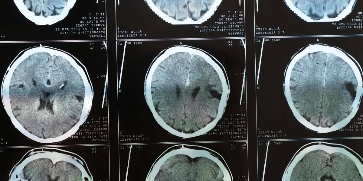 wernicke korsakoff syndrome scan